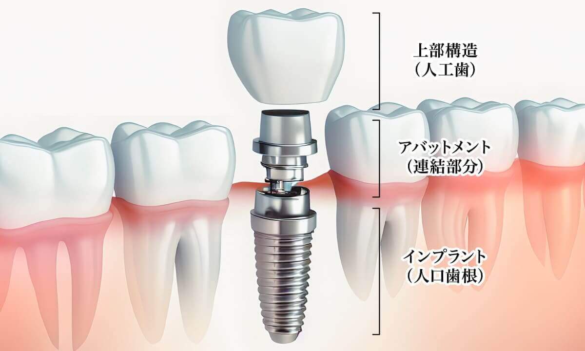 インプラント埋入治療｜先進的な機器で治療を行なう東住吉のさいのき歯科